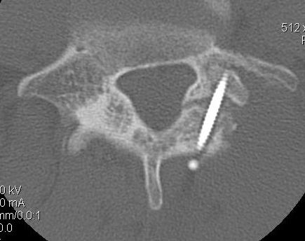 Pars Defect Screw CT